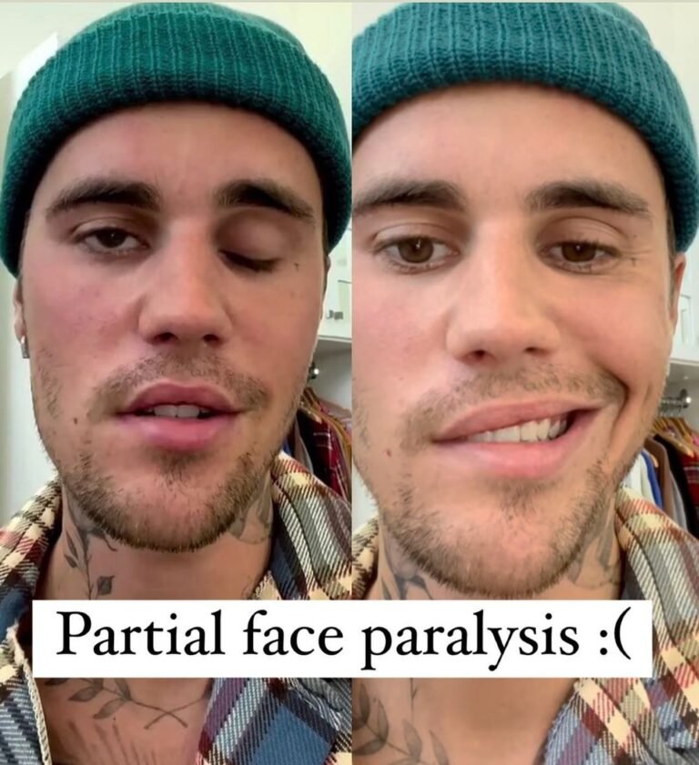 Justin Beiber cancels his shows after right side of his face gets paralysed afte